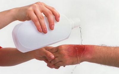Первая помощь при ожогах